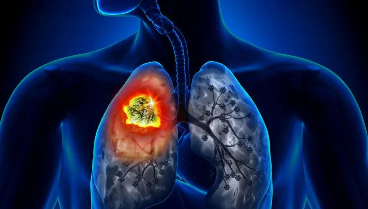 Ailesinde akciğer kanseri olanlar için risk artıyor: Bu belirtiler varsa dikkat!