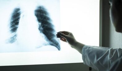 Akciğer kanserinde yeni tedavi yöntemi