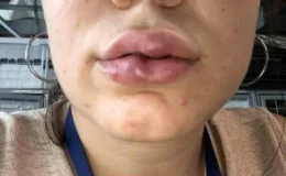 Bir estetikzede daha: Dudak dolgusu yaptırdı hayatı karardı