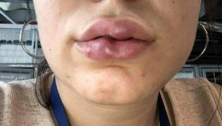 Bir estetikzede daha: Dudak dolgusu yaptırdı hayatı karardı