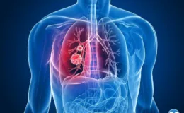 Erkeklerde birinci kadınlarda ikinci ölümcül kanser türü: Sigara kullanımına bağlı akciğer kanserinde umut artıyor!