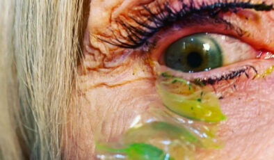 Gözünüzdeki lensi çıkarmazsanız ne olur? Bir kadın 23 gün boyunca bunu yaptı sonuç şok!