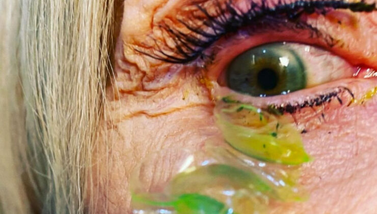 Gözünüzdeki lensi çıkarmazsanız ne olur? Bir kadın 23 gün boyunca bunu yaptı sonuç şok!