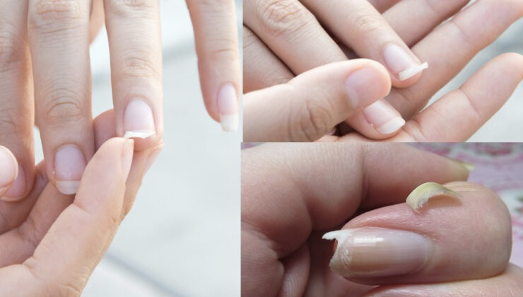 Hemen tırnaklarınıza bakın eğer bu belirtiler varsa çok ciddi bir hastalığınız olabilir