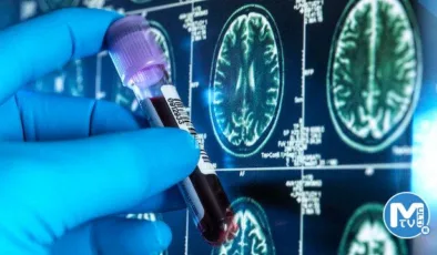 Bilim insanları Alzheimer hastalığı için kan testi geliştirdi
