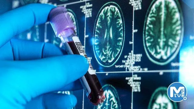 Bilim insanları Alzheimer hastalığı için kan testi geliştirdi