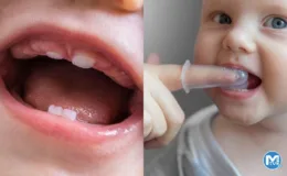 Diş çıkarma: Bebeğinizin ilk dişleri