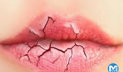 Dudak Dolgusu İle İlgili Bilinmesi Gereken Her Şey