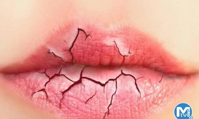 Dudak Dolgusu İle İlgili Bilinmesi Gereken Her Şey