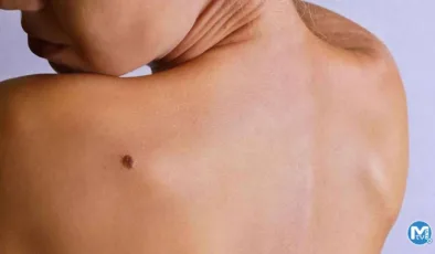 Et beni neden olur, neden çıkar? Et beni tedavisi nasıl olur?