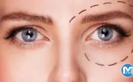 Göz Kapağı Düşüklüğü Ameliyatı