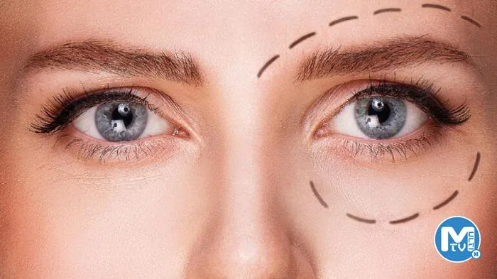 Göz Kapağı Düşüklüğü Ameliyatı