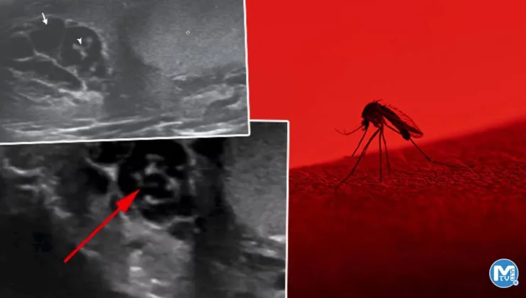 Her şey bir sivrisinek ısırığı ile başladı… Korkunç gerçeği ultrason çektirince öğrendi: Düzinelerce solucan vücudunda haftalarca yaşadı