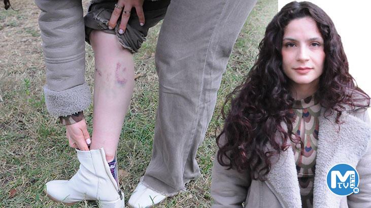 Köpeklerin saldırısında yaralanan Duygu, yaşananları anlattı