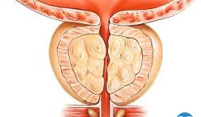 Lazerle Prostat Ameliyatı: Holep, Thulep ve Greenlight