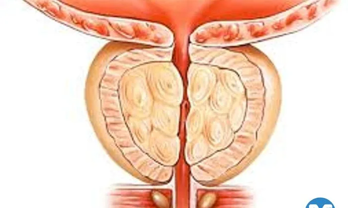 Lazerle Prostat Ameliyatı: Holep, Thulep ve Greenlight