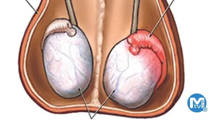 Testis Kanseri Neden Olur?