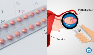 Doğum kontrol hapı, polikistik over sendromlu kadınlarda tip 2 diyabet riskini azaltabilir