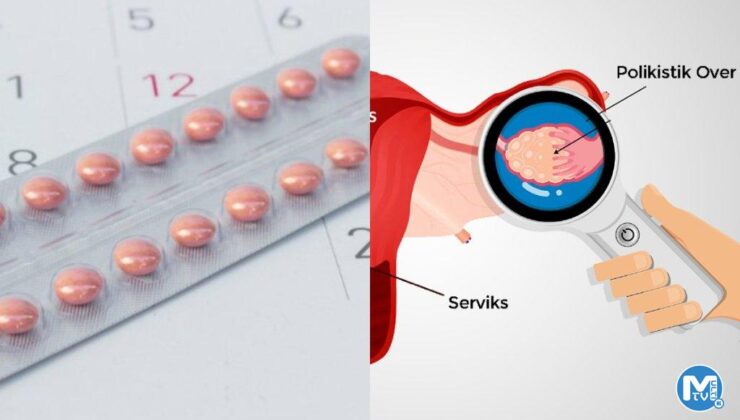 Doğum kontrol hapı, polikistik over sendromlu kadınlarda tip 2 diyabet riskini azaltabilir