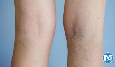 Varis oluşumunu durdurmak için 4 öneri – Varisi engellemek için ne yapmalı?