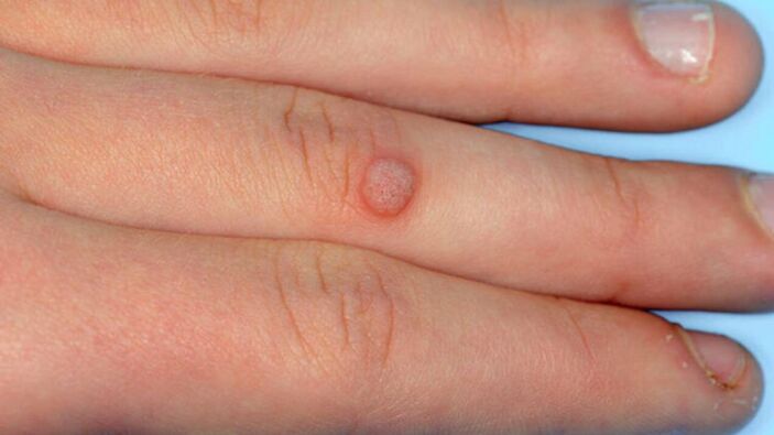 Siğilleri yok etmek için 10 doğal çözüm