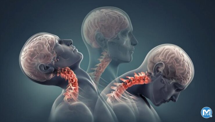 Boyun fıtığına ne iyi gelir? Boyun fıtığı egzersizleri nelerdir? Boyun fıtığı belirtileri…